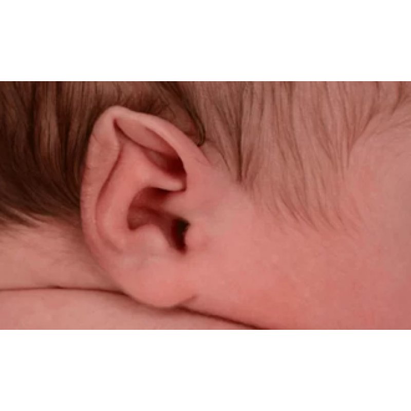 Yenidoğan Kulak Şekil Bozuklukları: Tanı, Tedavi ve İlgili Bilgiler