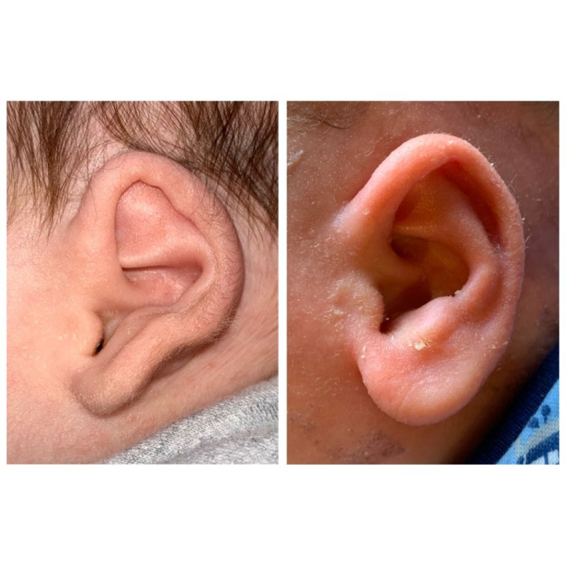 Yenidoğan Kulak Şekil Bozuklukları: Tanı, Tedavi ve İlgili Bilgiler