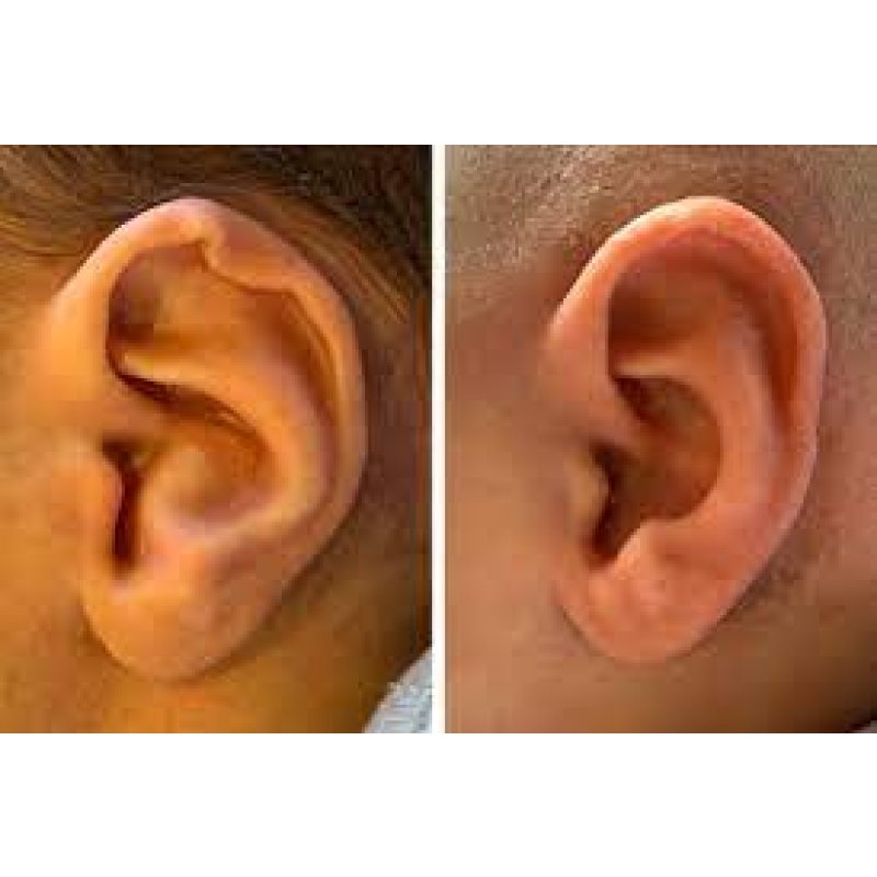 Yenidoğan Kulak Şekil Bozuklukları: Tanı, Tedavi ve İlgili Bilgiler